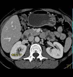 Normal Hepatic Veins in 3D - CTisus CT Scan