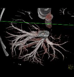 Normal Hepatic Veins in 3D - CTisus CT Scan