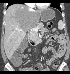 Hemangioma - CTisus CT Scan