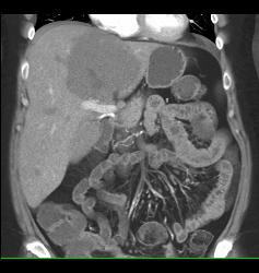 Hemangioma - CTisus CT Scan