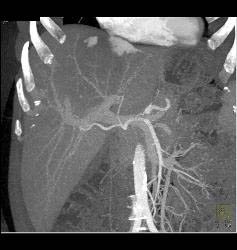 Hemangioma - CTisus CT Scan