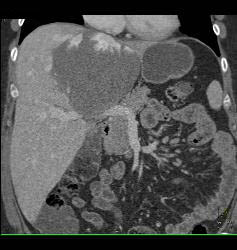 Hemangioma - CTisus CT Scan