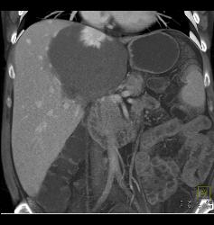 Hemangioma - CTisus CT Scan