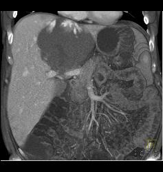 Hemangioma - CTisus CT Scan