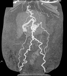 Cirrhosis With Varices - CTisus CT Scan