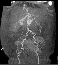 Cirrhosis With Varices - CTisus CT Scan