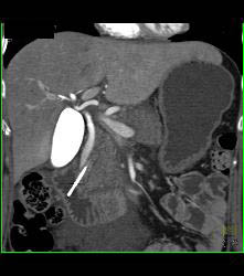 Post Endoscopic Retrograde Cholangiopancreatography (ERCP) With Nice Cystic Duct in 3D - CTisus CT Scan