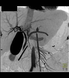 Post Endoscopic Retrograde Cholangiopancreatography (ERCP) With Nice Cystic Duct in 3D - CTisus CT Scan