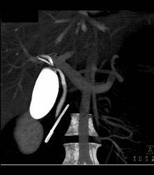 Post Endoscopic Retrograde Cholangiopancreatography (ERCP) With Nice Cystic Duct in 3D - CTisus CT Scan