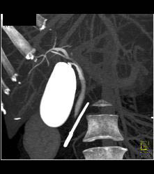 Post Endoscopic Retrograde Cholangiopancreatography (ERCP) With Nice Cystic Duct in 3D - CTisus CT Scan