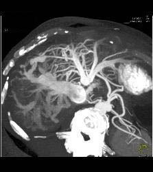 Portal Vein-hepatic Vein Shunting in Patient With Abdominal Pain - CTisus CT Scan