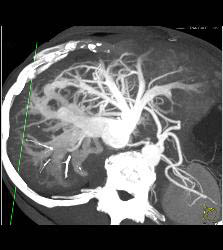 Portal Vein-hepatic Vein Shunting in Patient With Abdominal Pain - CTisus CT Scan