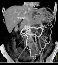 Collaterals Due to Splenic Vein Occlusion - CTisus CT Scan