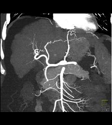 Cirrhosis With Pruning of Arterial Vessels and Collateral Flow on Venous Phase Images- See Full Sequence - CTisus CT Scan