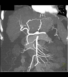 Cirrhosis With Pruning of Arterial Vessels and Collateral Flow on Venous Phase Images- See Full Sequence - CTisus CT Scan