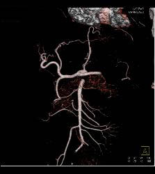 Cirrhosis With Pruning of Arterial Vessels and Collateral Flow on Venous Phase Images- See Full Sequence - CTisus CT Scan