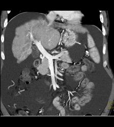 Cirrhosis With Pruning of Arterial Vessels and Collateral Flow on Venous Phase Images- See Full Sequence - CTisus CT Scan