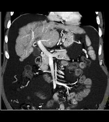 Cirrhosis With Pruning of Arterial Vessels and Collateral Flow on Venous Phase Images- See Full Sequence - CTisus CT Scan