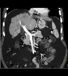 Cirrhosis With Pruning of Arterial Vessels and Collateral Flow on Venous Phase Images- See Full Sequence - CTisus CT Scan