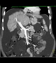 Cirrhosis With Pruning of Arterial Vessels and Collateral Flow on Venous Phase Images- See Full Sequence - CTisus CT Scan