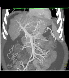 Cirrhosis With Pruning of Arterial Vessels and Collateral Flow on Venous Phase Images- See Full Sequence - CTisus CT Scan