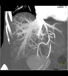 Reflux of Contrast Into IVC and Hepatic Veins - CTisus CT Scan