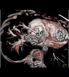 Reflux of Contrast Into IVC and Hepatic Veins - CTisus CT Scan