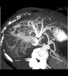 in This Case Shunting From Portal Vein (PV) to Hepatic Veins Is Seen - CTisus CT Scan