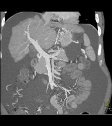 Cirrhosis Without Hepatocellular Carcinoma (Hepatoma) - CTisus CT Scan