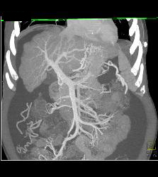 Cirrhosis Without Hepatocellular Carcinoma (Hepatoma) - CTisus CT Scan