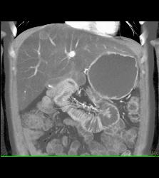 Fatty Liver - CTisus CT Scan