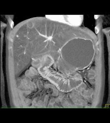 Fatty Liver - CTisus CT Scan