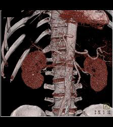 Post Liver Transplant With Hepatic Artery Flow Off Aortic Anastomosis - CTisus CT Scan