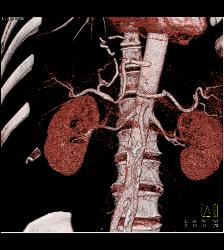 Post Liver Transplant With Hepatic Artery Flow Off Aortic Anastomosis - CTisus CT Scan