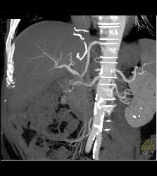 Post Liver Transplant With Hepatic Artery Flow Off Aortic Anastomosis - CTisus CT Scan