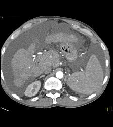 Post Liver Transplant With Hepatic Artery Flow Off Aortic Anastomosis - CTisus CT Scan