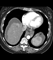 Arteriovenous (AV) Shunting in Cirrhosis - CTisus CT Scan