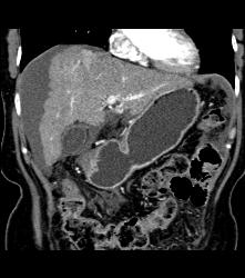 Arteriovenous (AV) Shunting in Cirrhosis - CTisus CT Scan