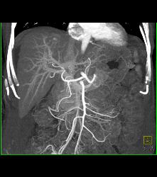 Arteriovenous (AV) Shunting in Cirrhosis - CTisus CT Scan