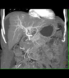 Arteriovenous (AV) Shunting in Cirrhosis - CTisus CT Scan