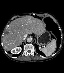 Cirrhosis With Subtle Hepatocellular Carcinoma (Hepatoma) - CTisus CT Scan