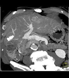 Cirrhosis With Subtle Hepatocellular Carcinoma (Hepatoma) - CTisus CT Scan