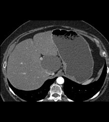 Hepatic Cyst - CTisus CT Scan