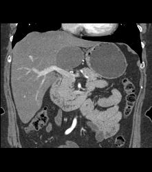 Hepatic Cyst - CTisus CT Scan