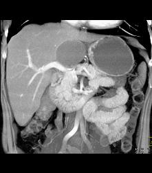 Hepatic Cyst - CTisus CT Scan