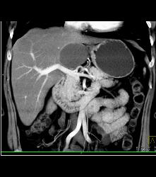 Hepatic Cyst - CTisus CT Scan