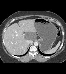 Hepatic Cyst - CTisus CT Scan