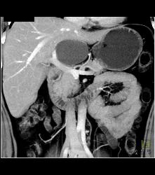 Hepatic Cyst - CTisus CT Scan