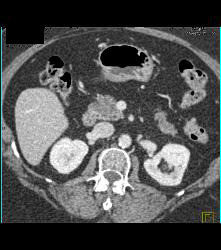 Cirrhosis of Liver With Texture Changes. Focal Fatty Infiltration of the Pancreas - CTisus CT Scan