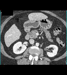 Cirrhosis of Liver With Texture Changes. Focal Fatty Infiltration of the Pancreas - CTisus CT Scan